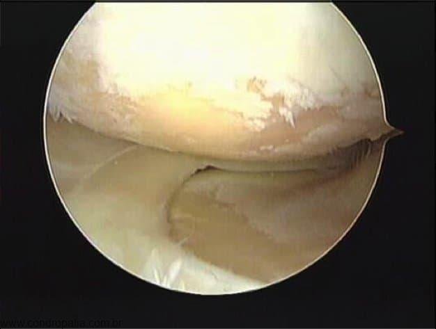 lesões osteocondrais, Condropatia e lesões osteocondrais, Ortopedista Especialista em Lesões da Cartilagem - DF